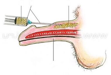 injekzio zakila handitzea